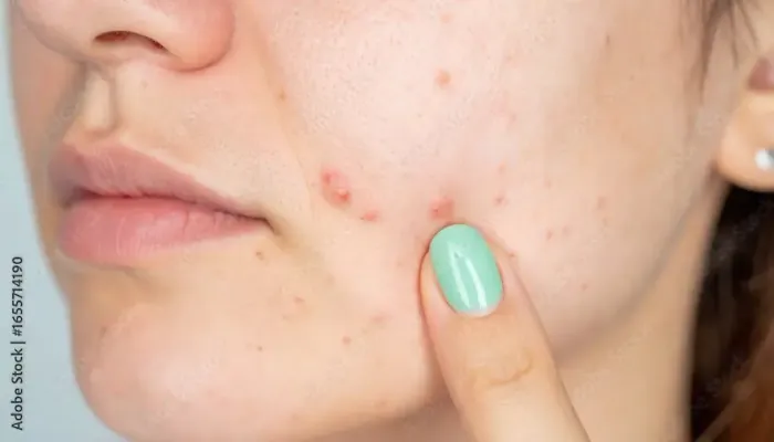 Understanding Facial Acne